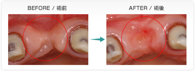 歯槽堤増大法術前・術後