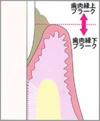 歯肉縁上プラークと歯肉縁下プラークの違い