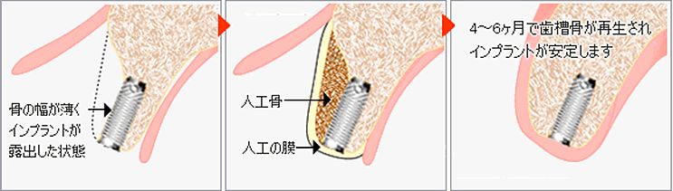 骨移植（GBR）とは？ イメージ