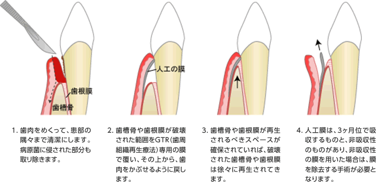 GTR法とは？ イメージ