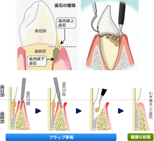 スケーリングを行った後の治療イメージ